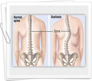 A critical analysis of what Scoliosis is all about