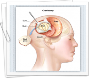 Know more about surgery and radiotherapy for brain cancer treatment