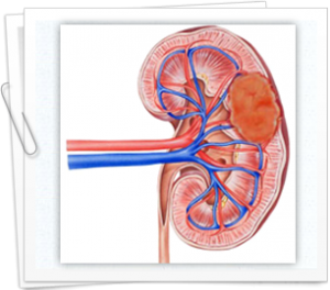 An introduction to kidney cancer