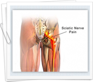 Lower back pains could be a sign of sciatica