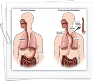 Re-evaluation of esophageal cancer treatments