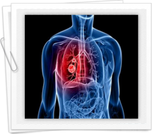 Understanding small cell lung cancer
